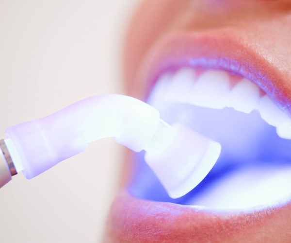 clareamento-dental-no-consultorio