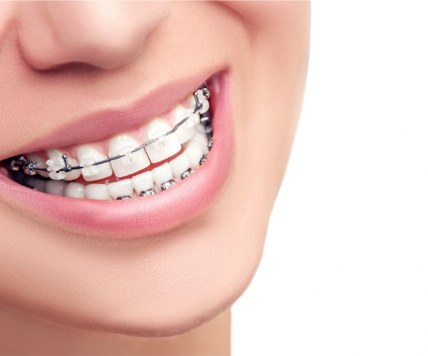 a-importancia-da-ortodontia-para-o-surgimento-de-n