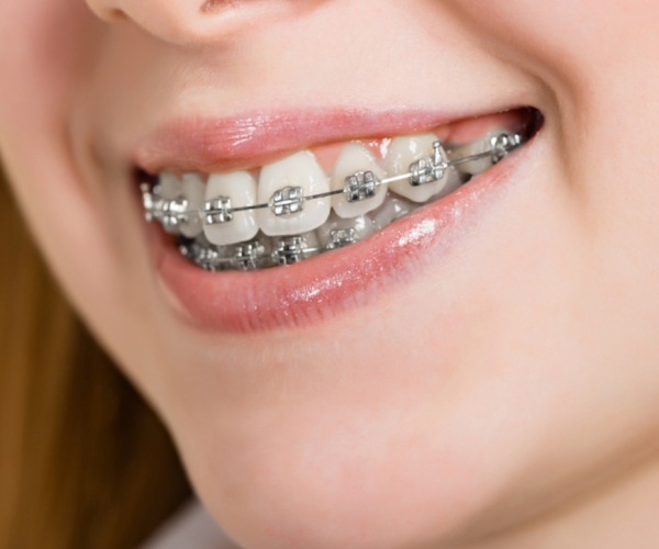 a-ortodontia-e-capaz-de-corrigir-o-alinhamento-dos